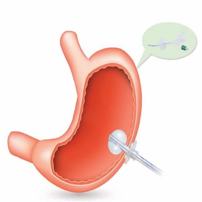High Quality Hospital Medical Consumables Percutaneous Endoscopic Gastrostomy PEG Kit with Medical Silicone supplier